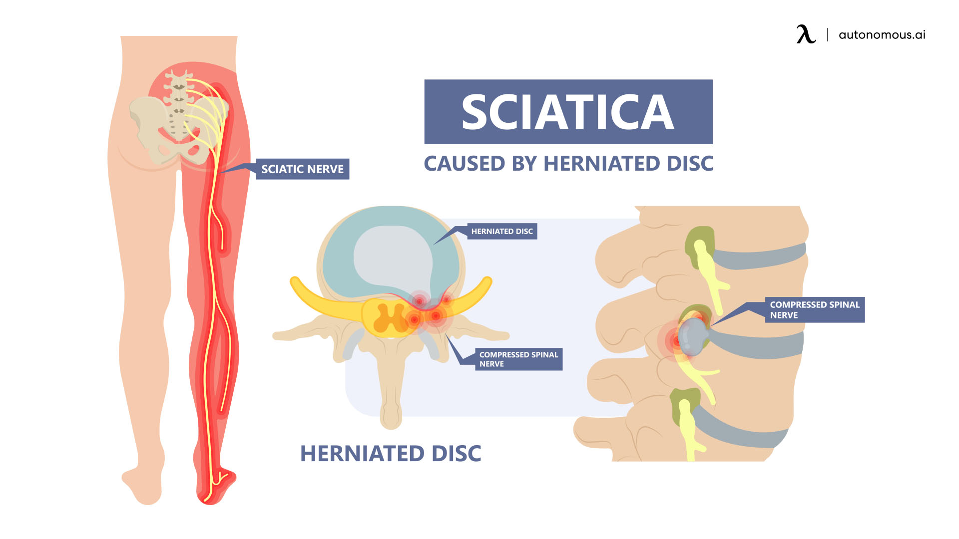 What is sciatica pain?
