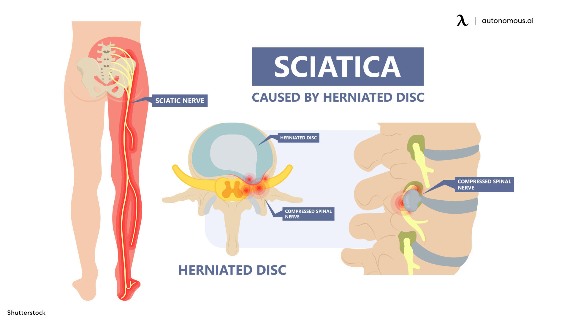 What is Sciatica Pain?
